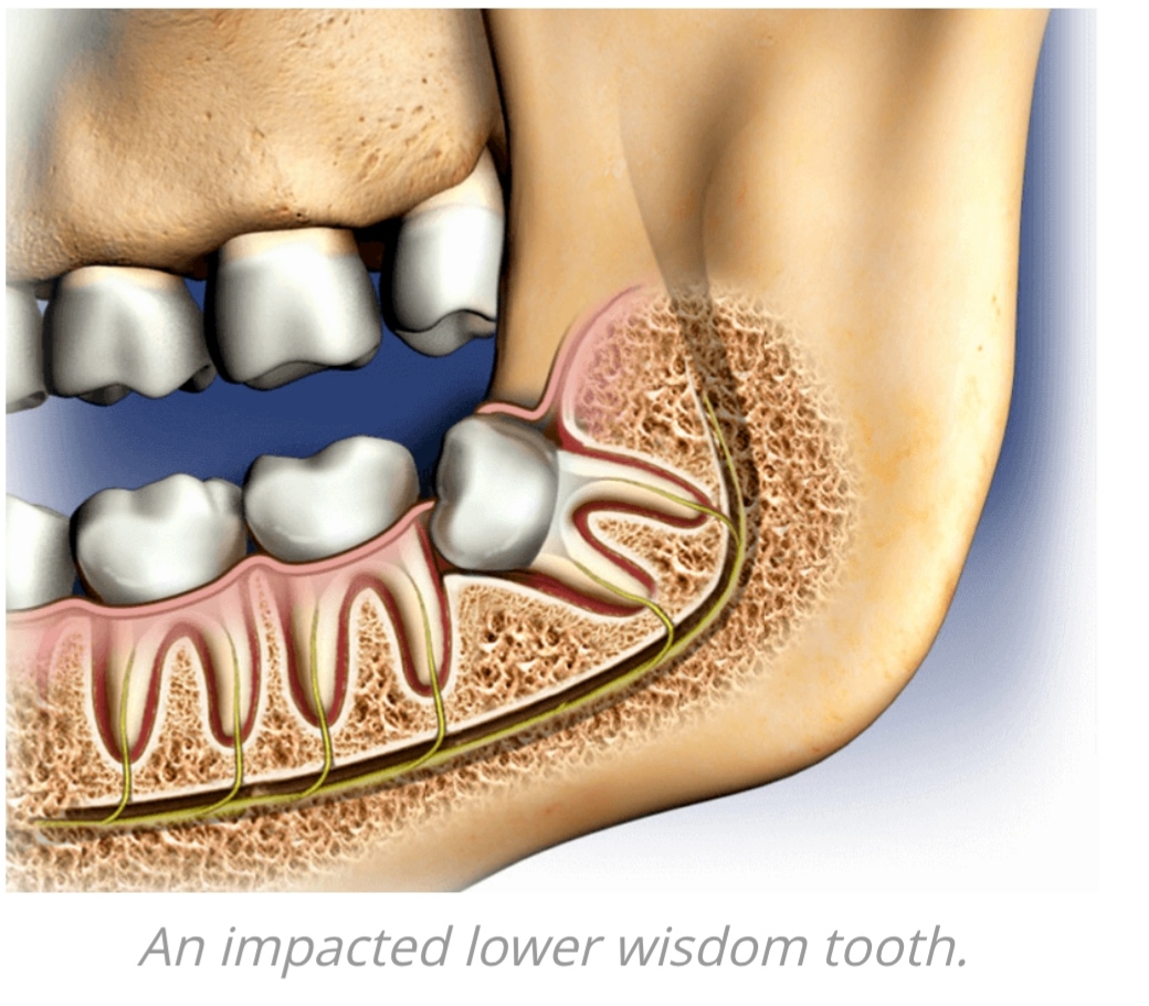 Impacted Wisdom Tooth