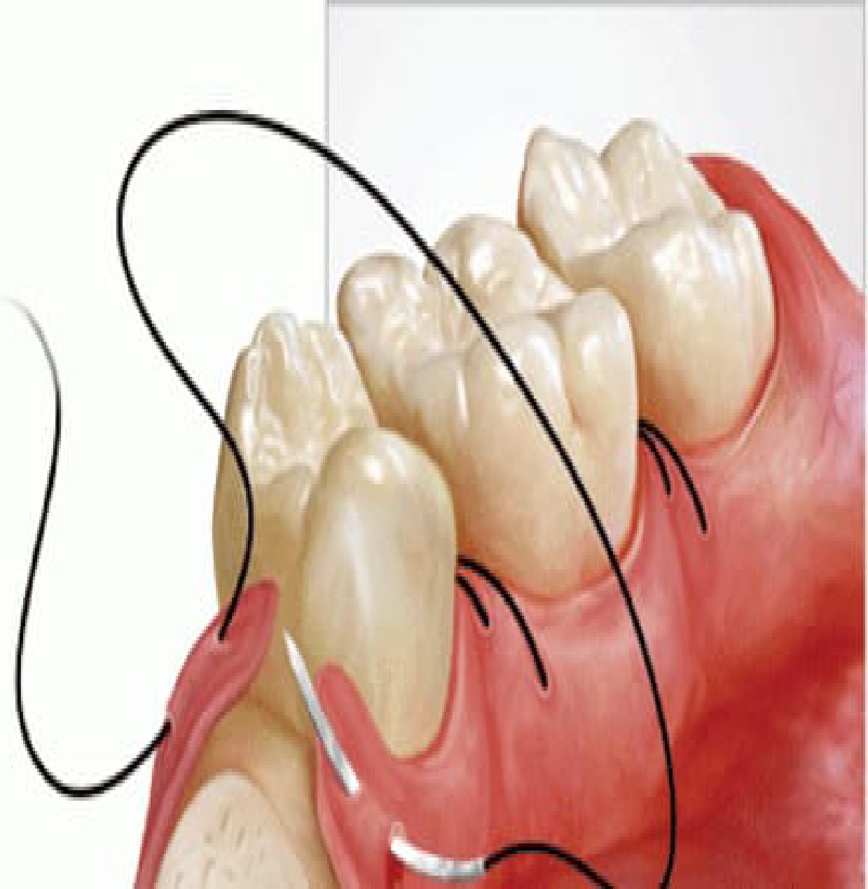 Gums Surgery