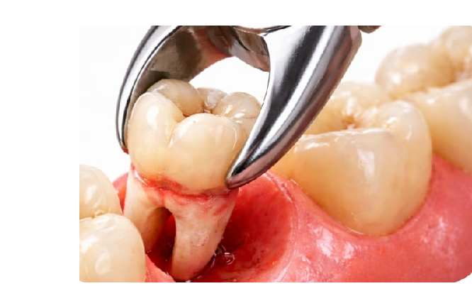 Tooth Extraction