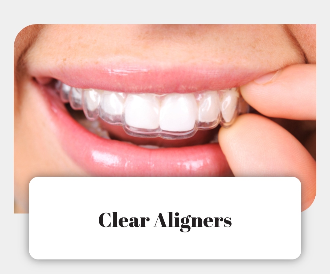Clear Aligners