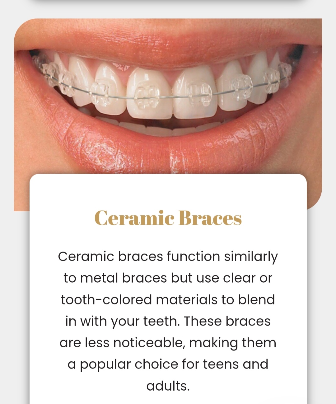 Ceramic Braces