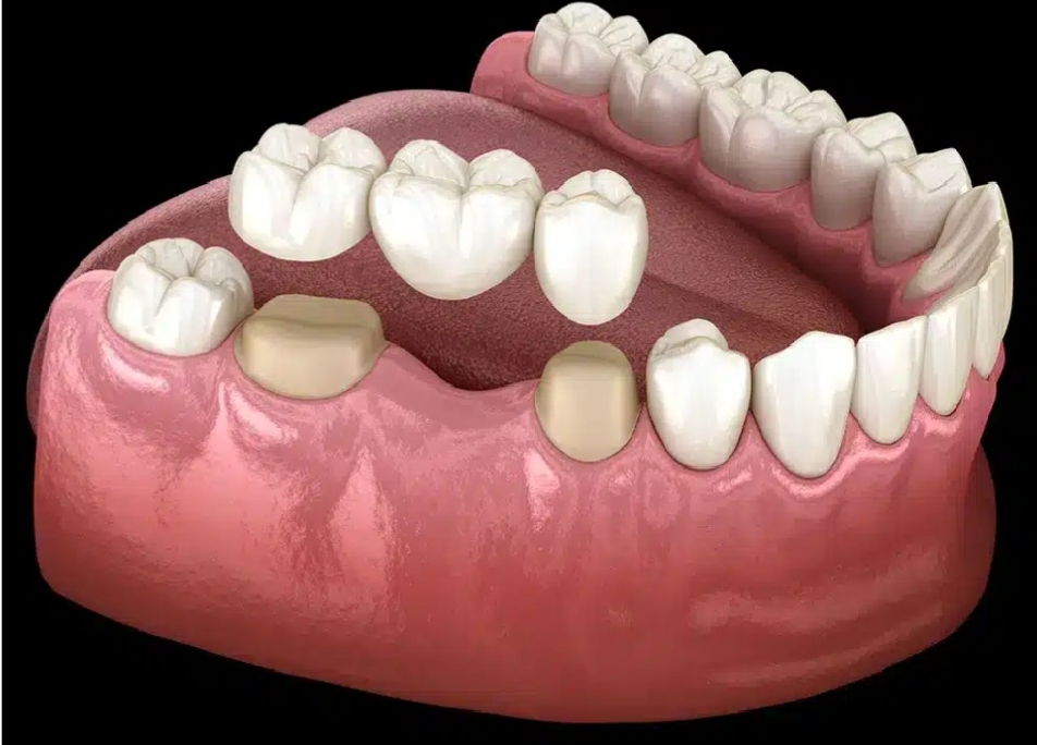 Dental Bridges