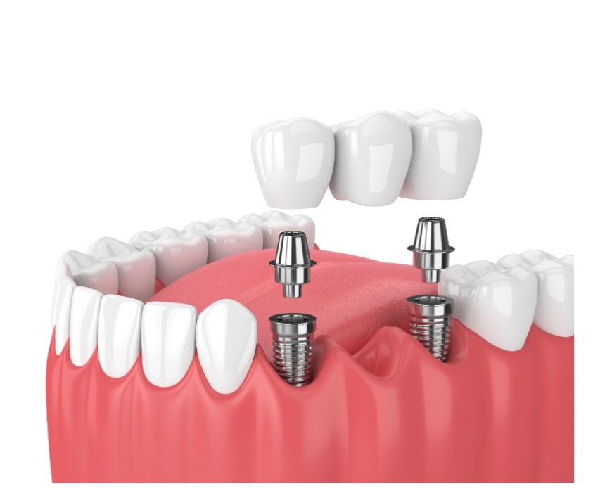 Dental Implants