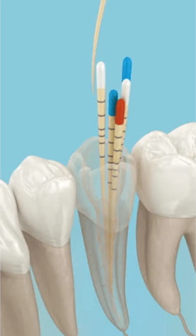 Root Canal Files