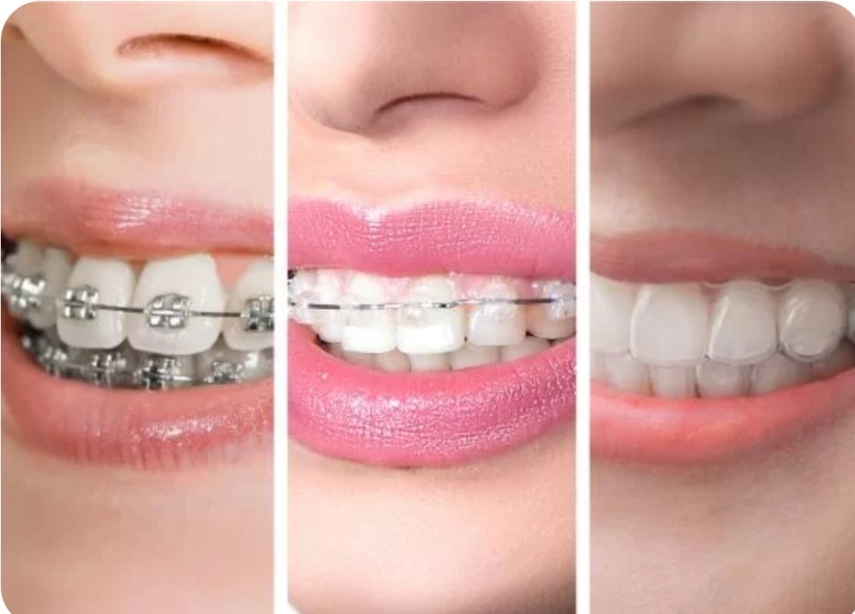 Braces Types